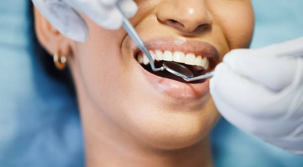 Best Knocked-Out Tooth (Avulsed Tooth) Treatment in Fruitland, ID